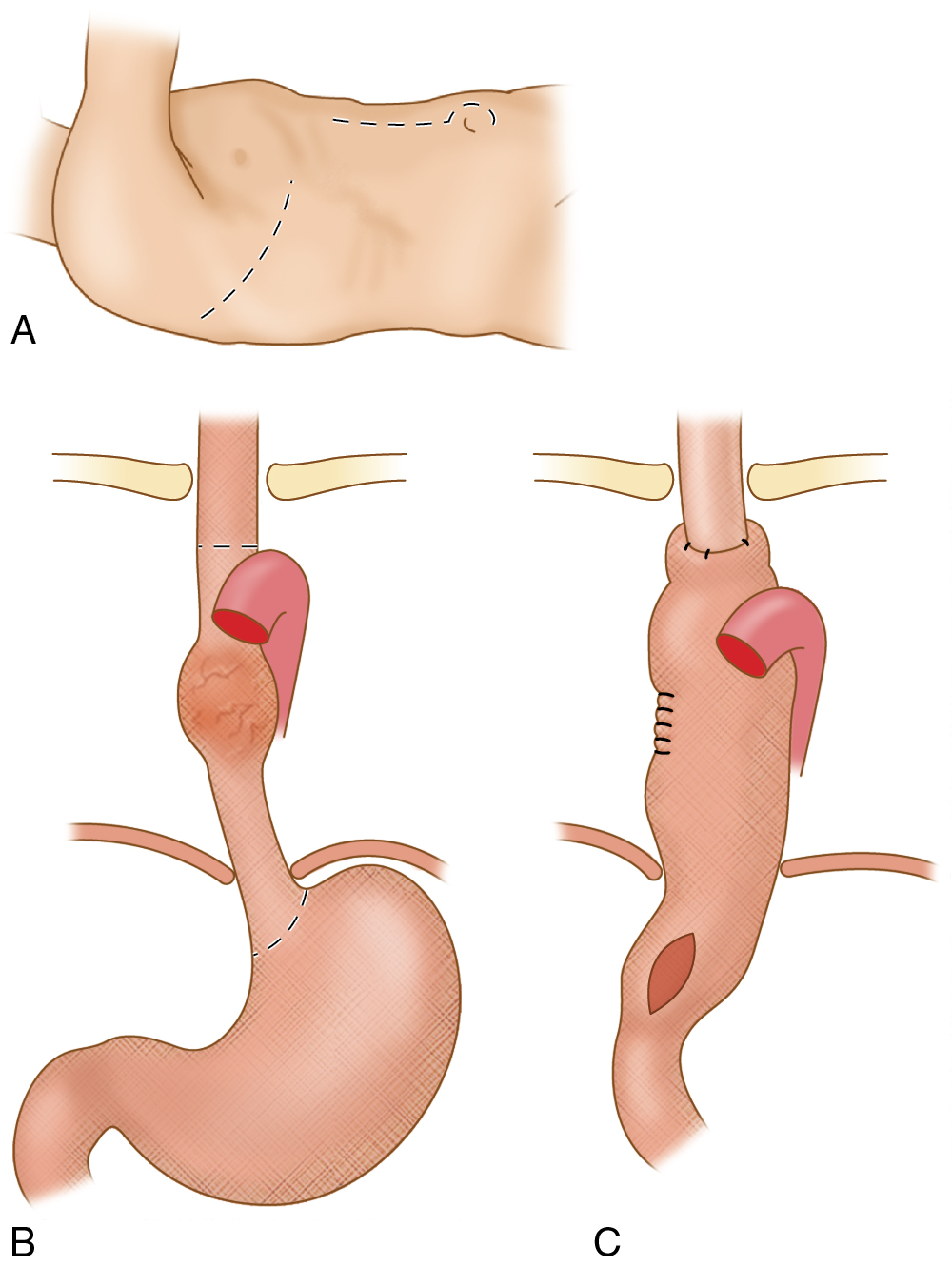 Fig. 7.1, Overview of right thoracotomy (A) with esophageal resection, (B) gastric mobilization, and (C) intrathoracic anastomosis.