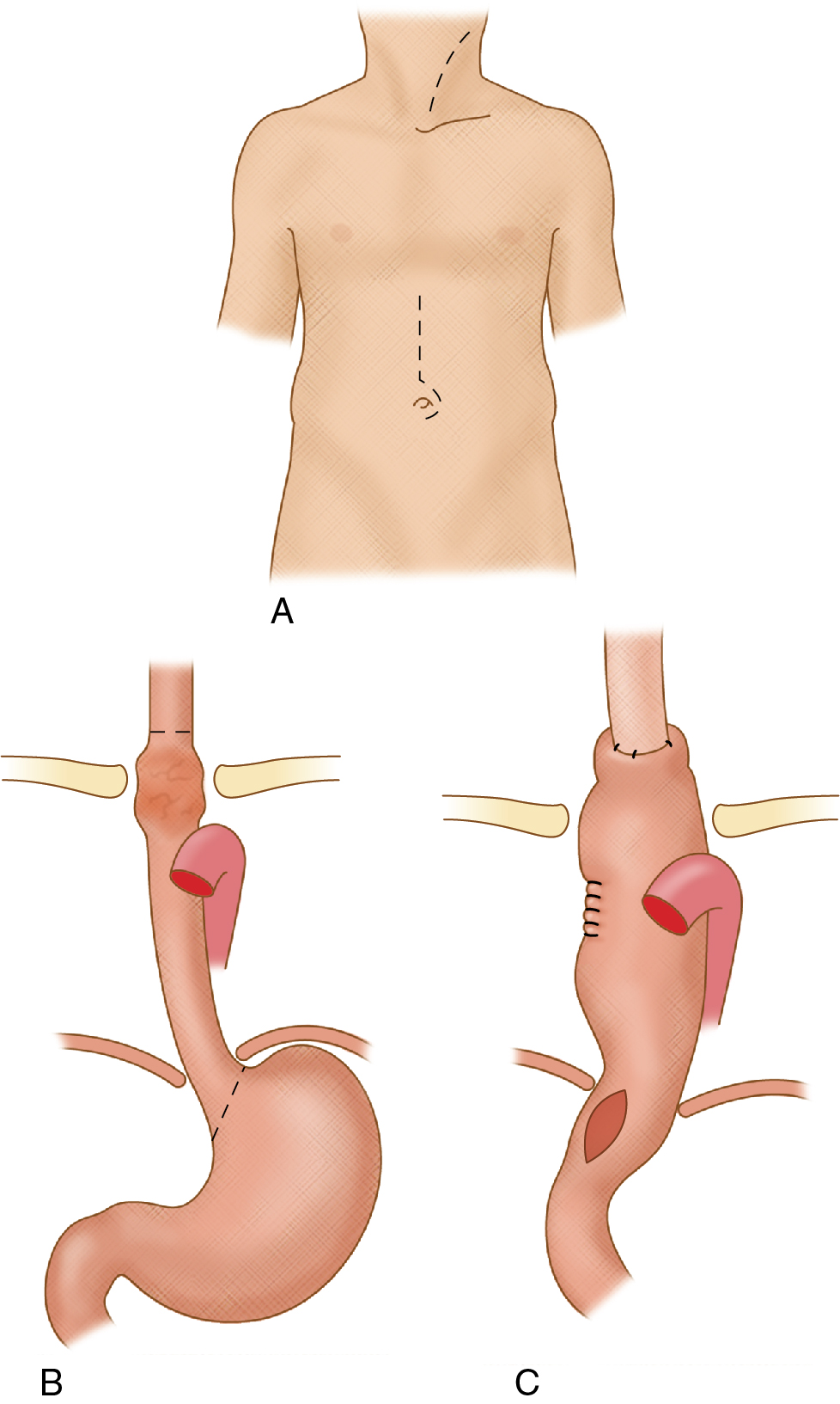 Fig. 7.2, Overview of transhiatal esophagectomy (A) with gastric mobilization and gastric pull-up (B) for cervicoesophagogastric anastomosis (C).