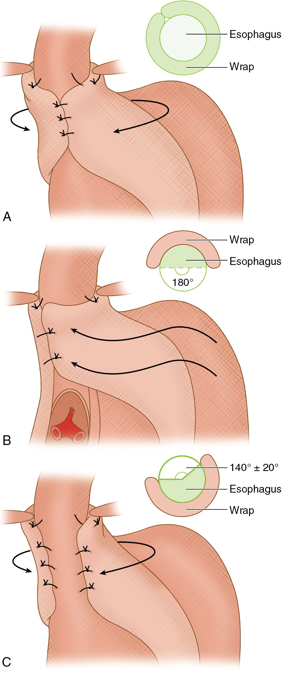 Fig. 7.3, Overview of the most common fundoplications. A, Nissen fundoplication. B, The Belsey Mark IV repair is performed transthoracically, whereas the Hill procedure (C) is performed via the abdominal route.