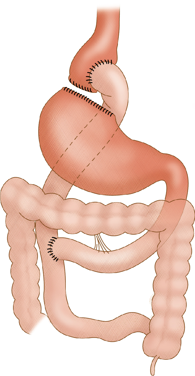 Fig. 7.4, Roux-en-Y gastric bypass.