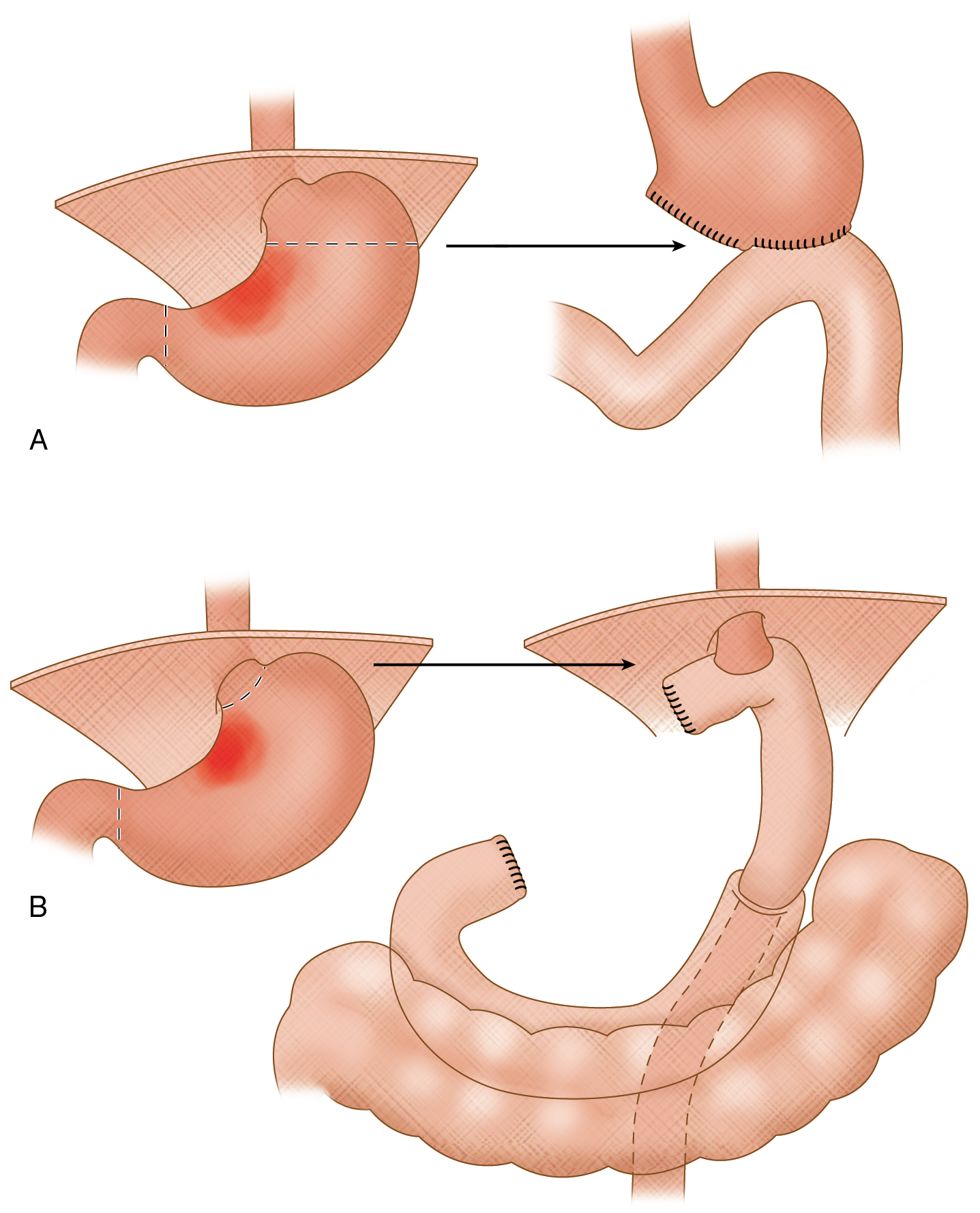 Fig. 7.5, A, Total gastrectomy with a Roux-en-Y anastomosis. B, Subtotal gastrectomy with a Billroth II anastomosis.