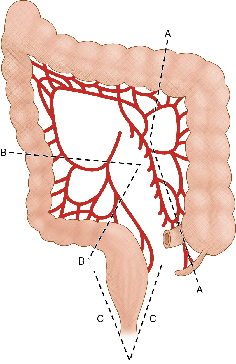 Fig. 7.6, Operative procedures for right-sided colon cancer, sigmoid diverticulitis, and low-lying rectal cancer. Right hemicolectomy involves resection of the terminal ileum and colon up to the division of the middle colic vessels (A). Sigmoidectomy consists of removing colon between the partially retroperitoneal descending colon and the rectum (B). Abdominoperineal resection of the rectum is a combined approach through the abdomen and perineum with resection of the entire rectum (C).