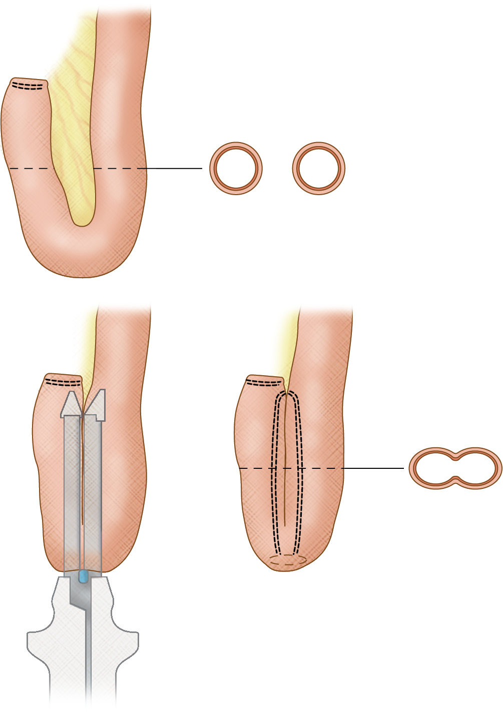 Fig. 7.7, Creation of an ileal J-pouch with a linear stapler.