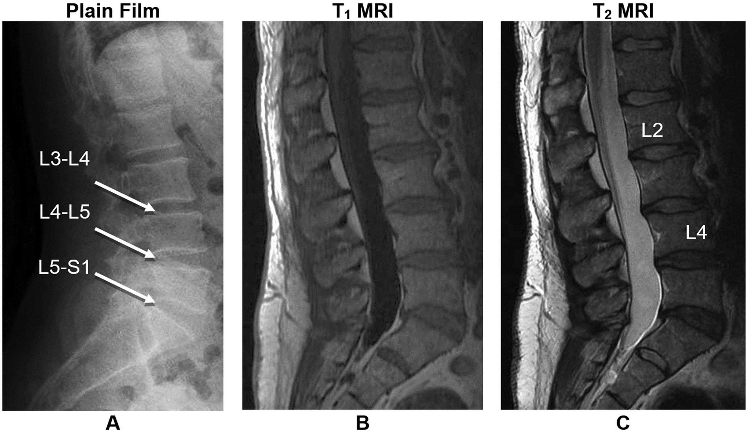 Figure 5.1, Comparison of plain film X-ray radiograph and MRI. While plain film (A) of a 46-year-old LBP patient readily shows mild loss of intervertebral disc height, worst at L3–4, L4–5, and L5–S1 discs (indicated by arrows ), the corresponding T 1 MRI (B) and T 2 MRI (C) show more details. Multilevel degenerative changes were observed including hemangiomas at L2 and L4 vertebral bodies on the T 2 MRI, and small diffuse disc bulges minimally impressing the ventral thecal sac at L2–L3, L3–L4, and L4–L5 were observed on both MRIs.