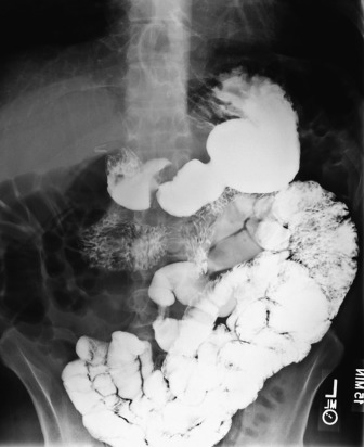 Figure 24-1, Fifteen-minute overhead radiograph of normal small bowel follow-through examination.