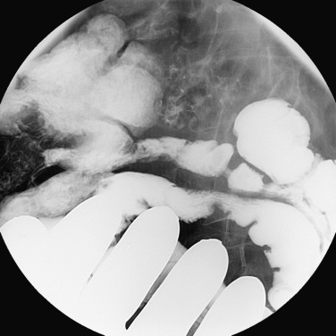 Figure 24-2, Spot fluoroscopic image of normal terminal ileum with manual compression.