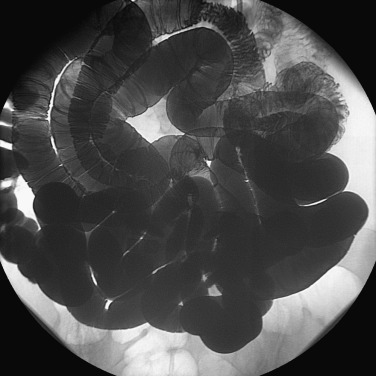 Figure 24-3, Normal findings of small bowel enteroclysis.