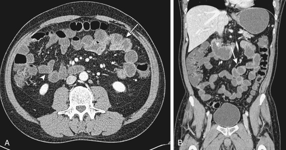 Figure 24-4, Axial (A) and coronal (B) images of normal computed tomography enterography. Enhancement of normal jejunal loops (arrows) is greater than that of normal ileal loops (arrowhead).