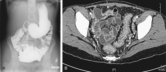 Figure 24-5, Small bowel follow-through (SBFT) and computed tomography (CT) enterography in a patient with Crohn's disease. A, SBFT cannot evaluate the colon or overlapping small bowel loops in the pelvis. B, CT enterography in the same patient performed after SBFT shows segmental mural thickening and hyperenhancement of an ileal loop (arrow) and acute colonic inflammation (arrowhead).