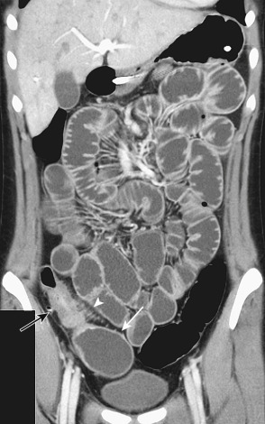 Figure 24-6, Computed tomography enteroclysis with intravenous and neutral enteric contrast material in a patient with Crohn's disease. There is segmental mural thickening and hyperenhancement in the ileum (black arrow) with engorgement of the vasa recta (white arrowhead). Proximal ileal dilation (white arrow) indicates luminal stricture. Also note intrahepatic biliary dilation secondary to primary sclerosing cholangitis, which is an extraintestinal complication of Crohn's disease.