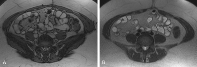 Figure 24-7, Axial true fast imaging with steady-state precession (FISP) (A) and axial T2-weighted half-Fourier acquisition single-shot turbo spin-echo (HASTE) (B) images demonstrate normal small bowel with normal wall thickness (≤3 mm) and signal. In this patient, 1000 mL of dilute barium sulfate was administered over 1 hour just before the examination to achieve adequate bowel distention.