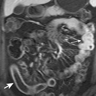 Figure 24-8, Coronal postgadolinium, T1-weighted, gradient-recalled-echo fat-saturation image demonstrates an abnormal segment of distal ileum in the right lower quadrant with mural thickening and hyperenhancement (thick arrow). Prominent perienteric vascularity is seen surrounding this segment. Adequate bowel distention allows for confident evaluation of the distal small bowel. This is in distinction to the jejunal loops in the left upper abdomen, which show apparent wall thickening because of lack of distention (thin arrow).