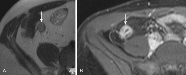 Figure 24-9, A, Axial T2-weighted half-Fourier acquisition single-shot turbo spin-echo (HASTE) image shows concentric wall thickening with the characteristic appearance known as the target sign (arrow). This implies acute inflammation in this patient with active Crohn's disease. B, Axial, postgadolinium, T1-weighted, gradient-recalled-echo, fat-saturation image in a different patient with active Crohn's disease again shows the characteristic target sign (arrow). Note the hyperenhancement of the mucosa and the decreased enhancement of the submucosa and muscularis layers due to edema.