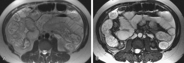 Figure 24-10, A, Axial T2-weighted half-Fourier acquisition single-shot turbo spin-echo (HASTE) image in a patient with small bowel obstruction. Oral contrast was not administered. There is distention of the bowel by intrinsic enteric contents. Bowel is normal thickness and signal. However, note the apparent intraluminal filling defects confirmed to be artifactual on true fast imaging with steady-state precession (FISP) images. B, Axial true FISP image in the same patient again demonstrates fluid-filled, dilated loops of small bowel with more homogeneous intraluminal opacification lacking the apparent flow voids seen on the HASTE image. Additionally, black boundary artifact is also present and characterized by the black line along the external surface of the bowel wall. This artifact is frequently seen on true FISP sequences.