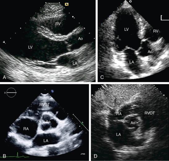 Fig. 8.2, Standard Transthoracic Echocardiographic Aortic Valve Imaging Planes.