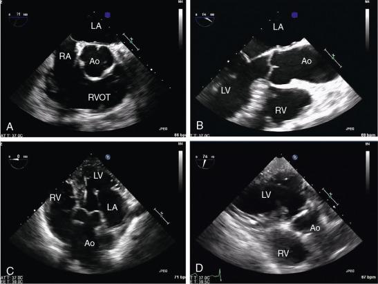 Fig. 8.3, Standard TEE Aortic Valve Imaging Planes.