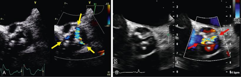 Fig. 8.6, Echocardiographic Diagnosis of Bicuspid Aortic Valve Stenosis.