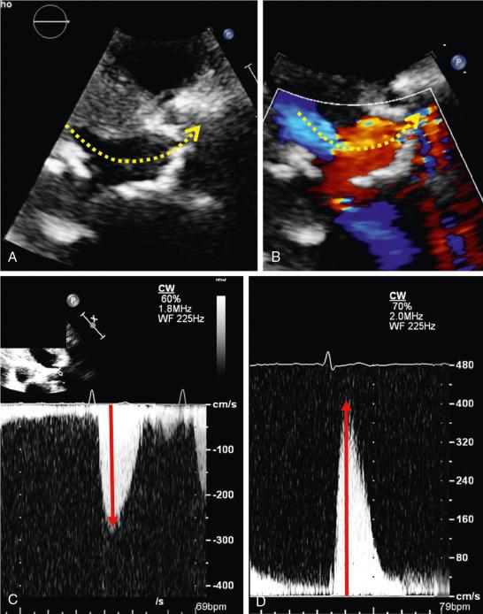 Fig. 8.7, Multiwindow Acquisition of Continuous-Wave Doppler Signal.