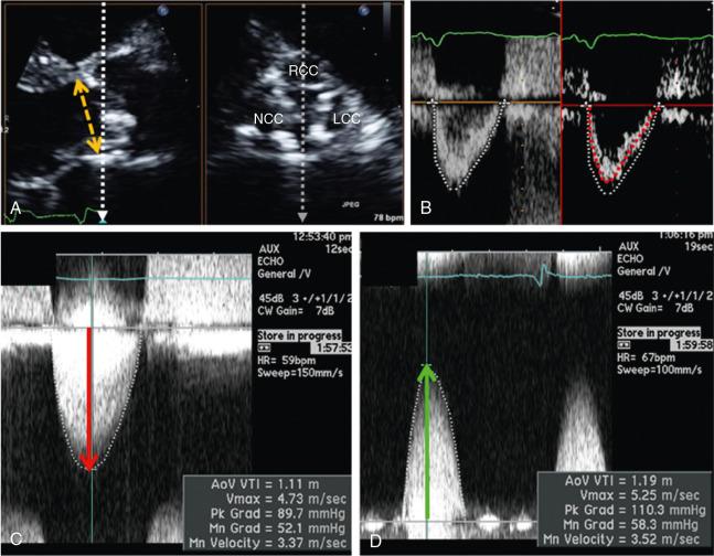 Fig. 8.8, Measurements Required for Calculation of the Aortic Valve Area by the Continuity Equation.