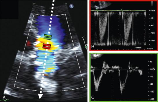 Fig. 8.10, Optimizing the Left Ventricular Outflow Tract (LVOT) Velocity-Time Integral Measurement.