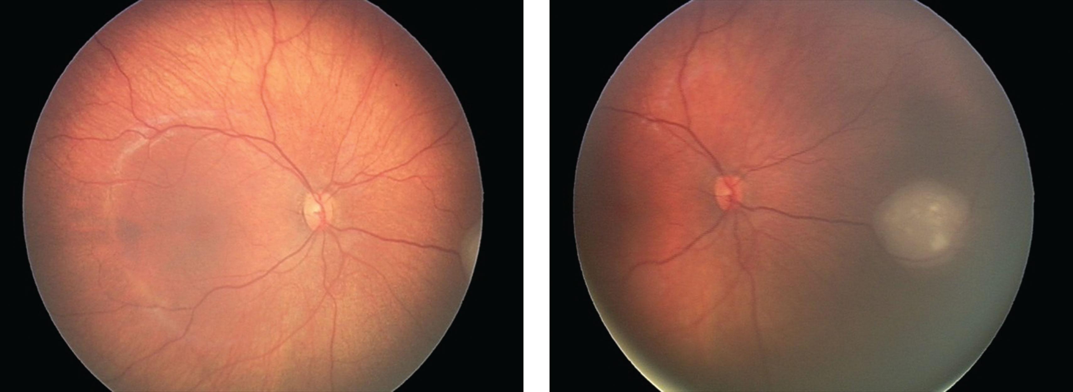 Fig. 8.2, Wide-field fundus photography of the right eye of a child with bilateral familial retinoblastoma using RetCam (Clarity Medical Systems, Inc., Pleasanton, CA). (A) Centered between the optic disc and fovea, the tumor is visible peripherally at 3 o’clock. (B) Centered more nasally, the tumor is visible in its full extent.