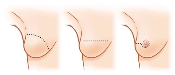 Fig. 11.1, Mastectomy incisions. Initially, a superior oblique incision was used (left), but this has evolved to a horizontal (middle) or periareolar (right) incision (with lateral extension when needed).