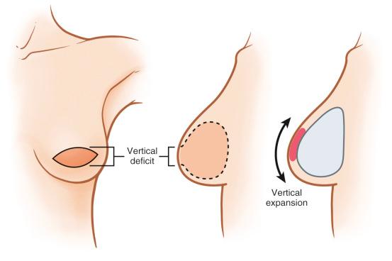 Fig. 11.2, The mastectomy defect results in a vertical skin deficit. This vertical deficit is what must be addressed through expansion.