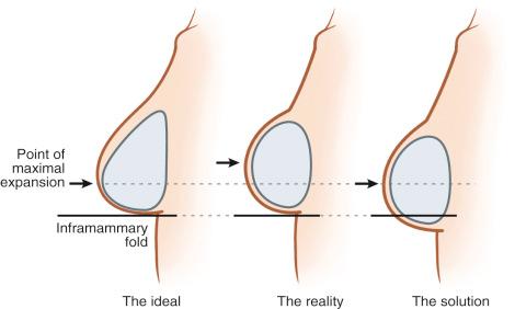 Fig. 11.3, The ideal point of expansion is in the lower third of the breast (left). Ideally, anatomically shaped expanders should achieve this point of expansion, but in reality, they result in expansion that is superior to this point (middle). Our technique has evolved, and we now place the expander 1–2 cm below the inframammary fold to account for this issue (right).