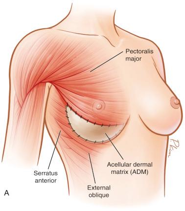 Fig. 10.2, Schematic diagrams (A and B) showing the placement of ADM and created pectoral/ADM pocket in immediate breast reconstruction.