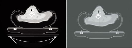 Fig. 4.3, A computed tomography (CT) image for a head and neck patient with and without a CT couch top.
