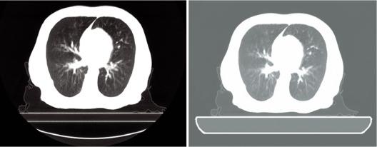 Fig. 4.4, A computed tomography (CT) image for a thoracic patient with the CT scanner couch top and with the digital treatment couch top.