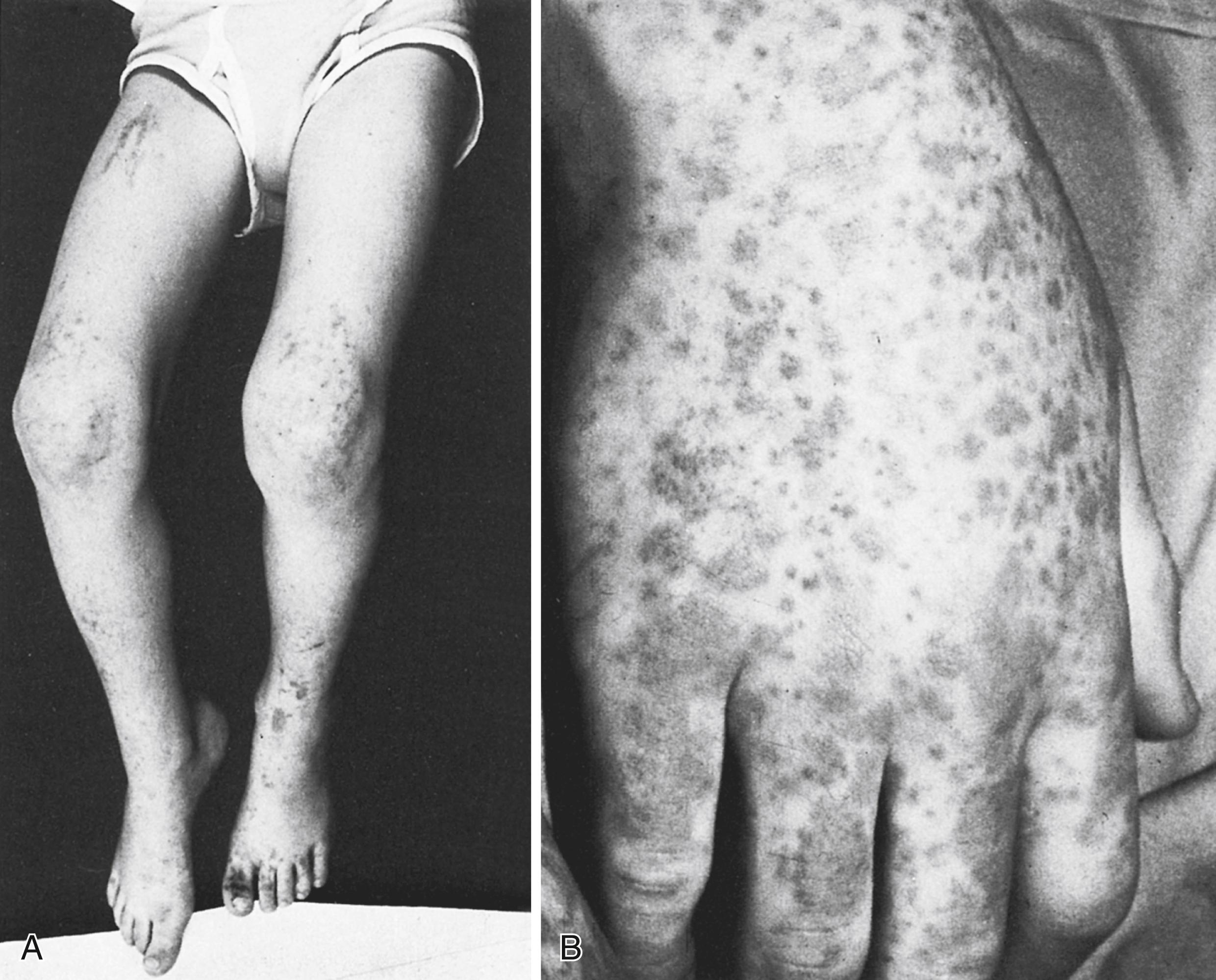 Fig. 33.2, IgA vasculitis. A , These purpuric lesions appeared on the lower extremities of a 10-year-old boy who had an acute, self-limited illness characterized by fever, arthritis, melena, and transient hematuria. Notice the periarticular swelling around the ankles and knees. B, Purpura on dorsum of the hand of a 14-year-old boy with IgA vasculitis.