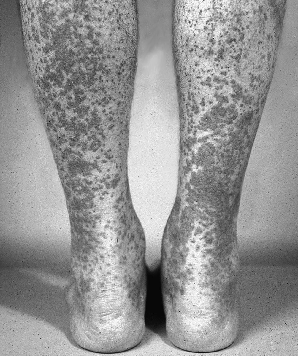 Fig. 33.3, Palpable purpuric lesions involve the heels and ankles of a patient with IgA vasculitis.