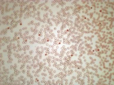 Figure 3-2, Acid elution technique of Kleihauer. Fetal red blood cells stain with eosin and appear dark. Adult red blood cells do not stain and appear as ghosts.