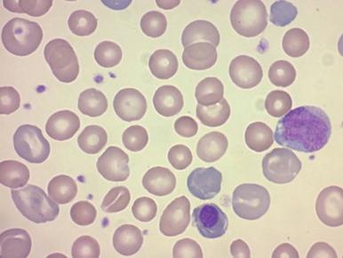 Figure 3-3, Neonatal blood sample of baby with severe Rh erythroblastosis fetalis who required an exchange transfusion at about 16 hours of age for progressive anemia with acidosis and rapidly rising bilirubin. Note the spherocytes, a promyelocyte, a nucleated red blood cell, and polychromasia.