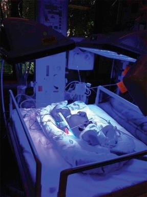 Figure 3-4, A baby receiving intensive phototherapy for anti-D hemolytic disease of the fetus and newborn. Umbilical catheters are in place for bilirubin and blood gas sampling and to undertake exchange transfusion if needed.