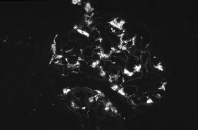 Figure 82.1, Post-infectious glomerulonephritis Immunofluorescence microscopy demonstrating relatively discrete granular staining of C3 along all glomerular capillary walls.