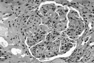 Figure 82.2, Antiglomerular basement membrane glomerulonephritis. Immunofluorescence microscopy demonstrating linear staining of IgG along all glomerular capillary walls.