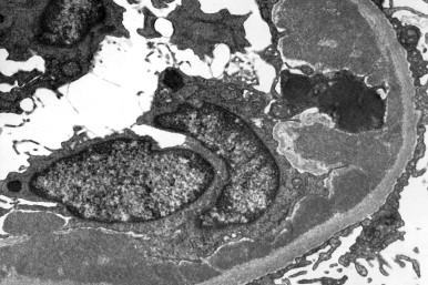 Figure 82.4, Membranoproliferative glomerulonephritis (MPGN). Mesangial hypercellularity and increased mesangial matrix with lobular accentuation. There is diffuse thickening of peripheral glomerular capillary walls (H&E, X330).