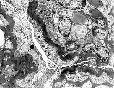 Figure 82.5, MPGN Silver stains showing double contoured glomerular capillary walls by enclosing silver-negative subendothelial deposits and mesangial interposition (Jones silver methenamine, X400).