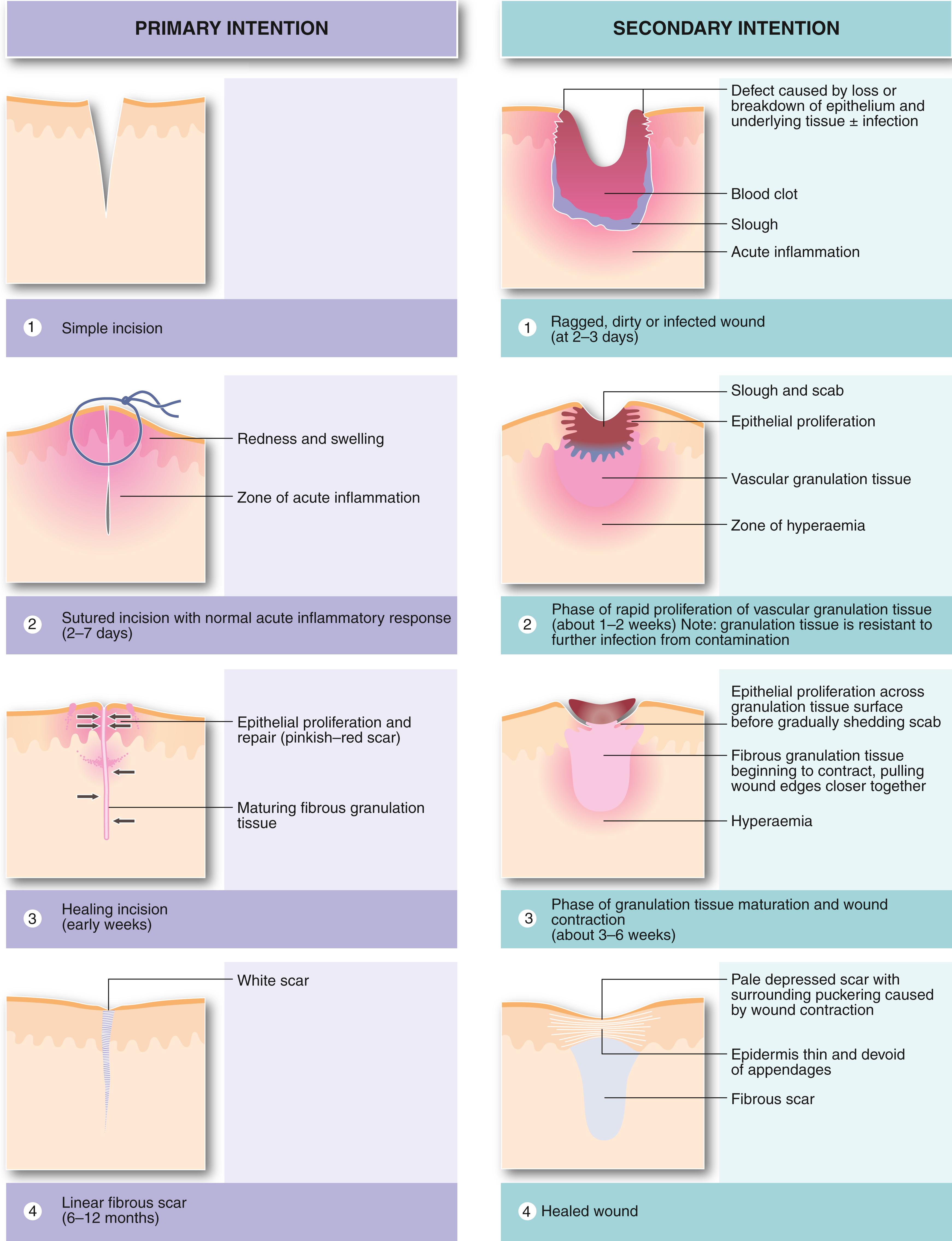 Fig. 3.4, Wound Healing by Primary and Secondary Intention.