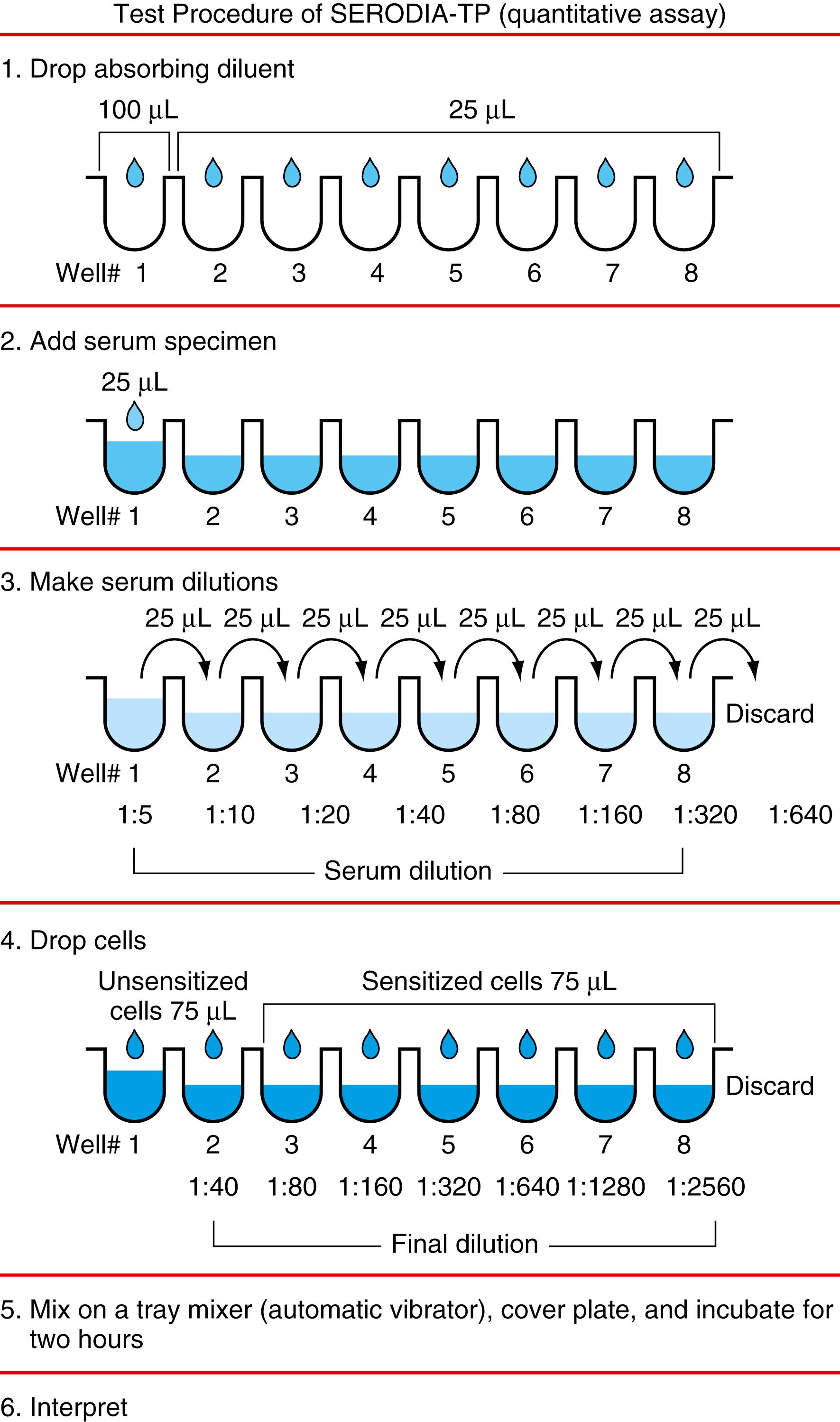 Figure 45.5, Hemagglutination assay for detection of Treponema pallidum antigen (Serodia-TP, Fujirebio, Inc., Tokyo, Japan) based on semiquantitative test protocols.