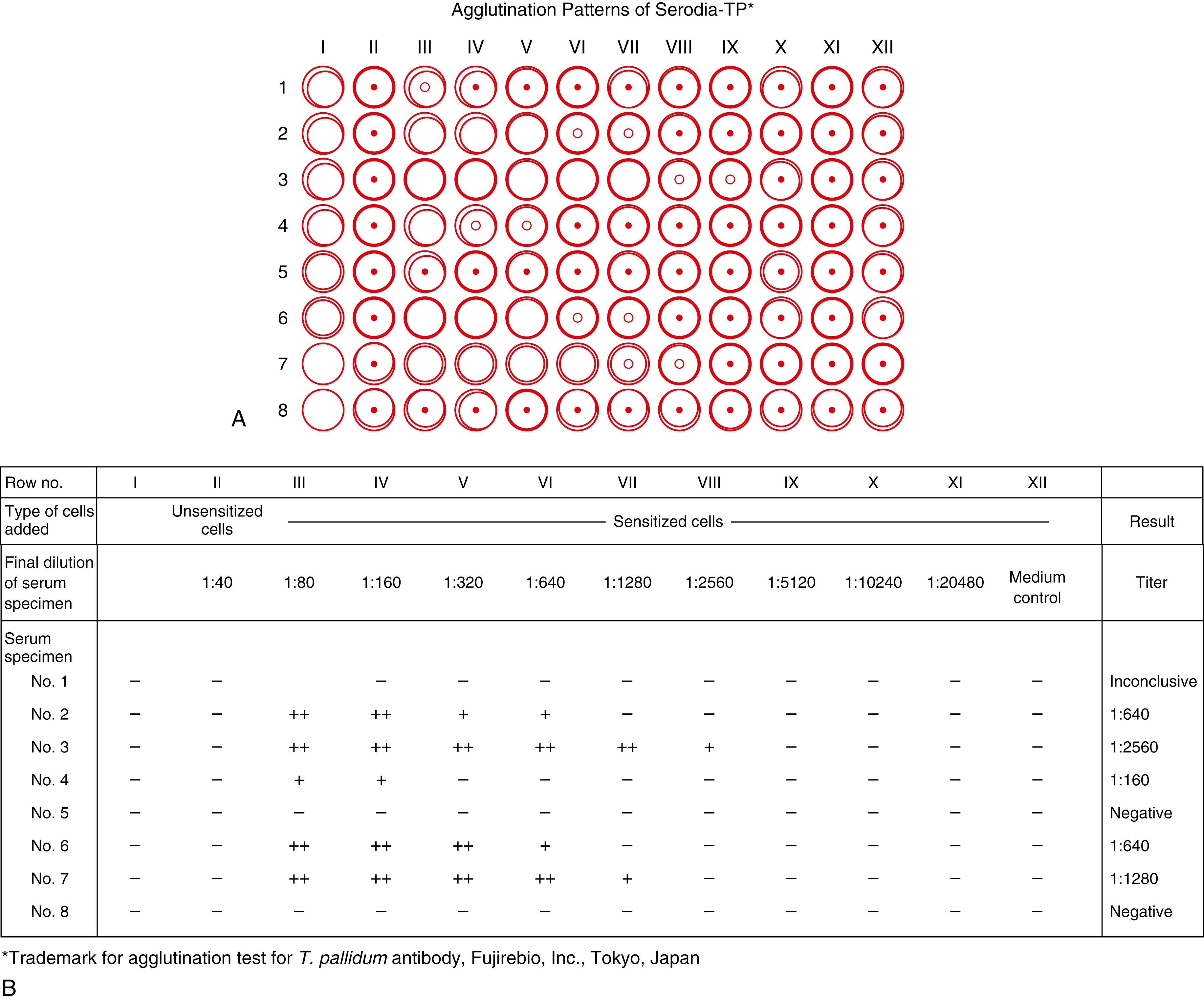 Figure 45.6, Hemagglutination patterns for detection of ( A ) anti– Treponema pallidum antibody, and ( B ) interpretation as positive or negative at final serum dilution.