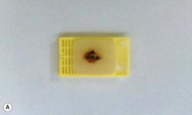 Figure 36-1, (A–D) Representative cell block specimen in cytopathology. A formalin-fixed, paraffin-embedded cell block specimen is generated by spinning the aspirate material into a pellet, which can then be submitted similar to a tissue block in surgical pathology in a cassette. (A) Once the sections are cut and placed on slides, they can be either stained with hematoxylin and eosin (B,C; H&E stain, ×LP and HP) or stained with special stains or immunostains. (D) A representative example of an immunostained cell block section is seen illustrating the on-slide control tissue and specimen, which undergo the same procedure and are stained with the same antibody.