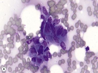 Figure 36-2, (A–C) Utility of immunocytology in determining cell type of origin. This is an example of an FNA of a bone lesion in an older woman with multiple suspicious lesions. The cytology of the Diff-Quik stained touch preparation showed cohesive clusters of cells with nuclear enlargement and irregular nuclear contours suspicious for malignancy (A, Diff-Quik, ×HP). The histologic sections of the core biopsy showed remodeling bone (upper right) and fibrous tissue with an infiltrate of dark cells (B, H&E stain, ×MP). A cytokeratin stain performed on the cell block revealed that the cells of interest were positive for cytokeratin, confirming a metastatic carcinoma (C, AE1/AE3 cytokeratin stain, ×HP).