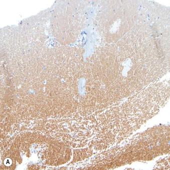 Figure 36-3, (A,B) Technical artifacts and pitfalls in interpretation of ICC. Immunostaining results may have technical artifacts, such as uneven staining, where the edge of the tissue shows nonspecific lighter or darker staining than the tissue that is more centrally located (A). There can also be high background staining of red blood cells, which can make interpretation of the cells of interest difficult (A). The cell block sections can also have floaters, air bubbles, or folded tissue obscuring the tissue (B).