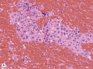 Figure 36-5, (A,B) Double immunostaining in lung adenocarcinoma. The aspirates and cell block from a lung mass showed features of a non-small-cell carcinoma (A, H&E stain, ×HP). A double immunostain for a nuclear marker (TTF-1) and a cytoplasmic marker (napsin A) was performed and revealed positivity in the cells of interest, confirming the diagnosis of an adenocarcinoma of lung origin (B, dual stain, ×HP).