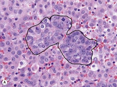 Figure 36-6, (A–D) Metastatic adenocarcinoma of lung origin in pleural fluid. The cytospin and cell block specimens showed cohesive clusters of tumor cells (circled) with slight nuclear enlargement, prominent nucleoli, elevated nuclear-to-cytoplasmic ratios, and mitotic figures, in a background of reactive mesothelial cells and histiocytes (H&E stain, ×HP). Immunostains performed to further characterize the cells revealed that the tumor cells were positive for MOC31 (B), while negative for WT-1 (C) and calretinin (D). In contrast, the reactive mesothelial cells in the background stain with the opposite pattern, showing positive staining for WT-1 and calretinin (C,D), and negative staining for MOC31 (B).