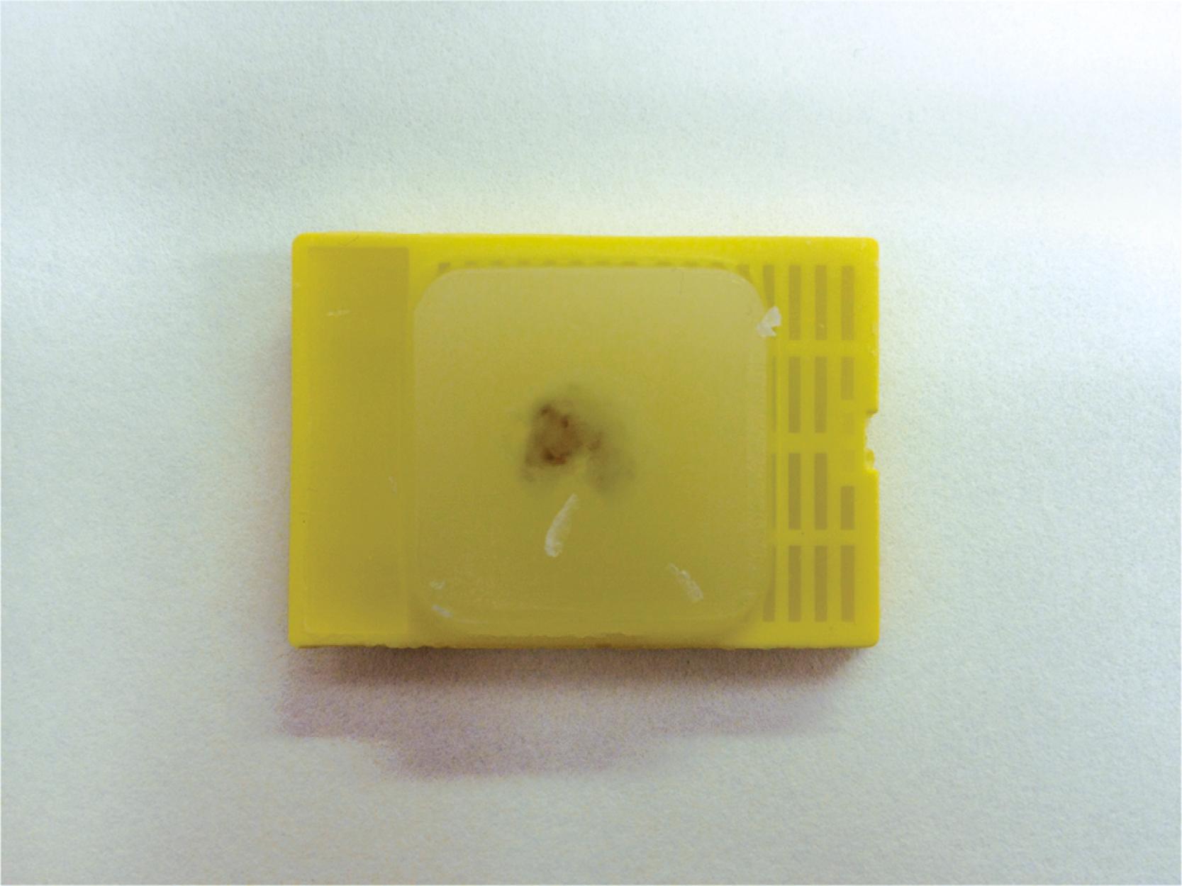 Fig. 21.1, Formalin-fixed, paraffin-embedded cell block. A cell block is similar to a tissue block in surgical pathology and can be used to generate numerous slides for immunocytochemistry.