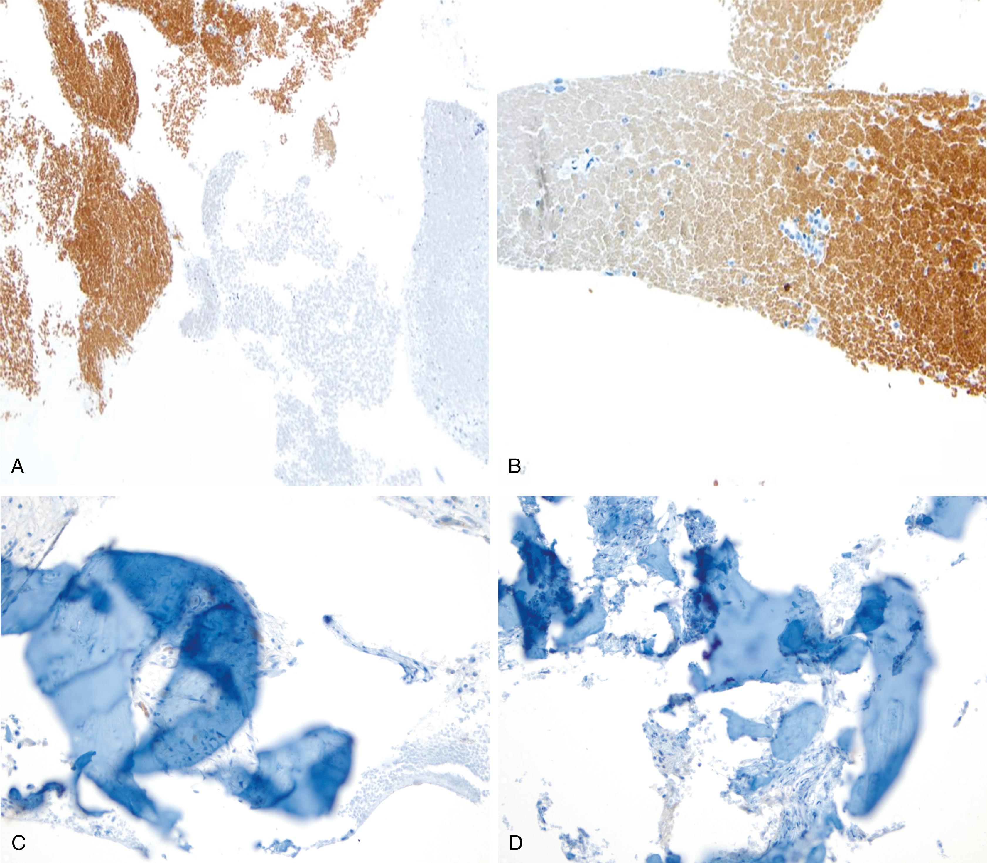 Fig. 21.5, (A–D) Technical artifacts and pitfalls in interpretation of immunocytochemistry include uneven staining and high background staining of red blood cells (A, original magnification ×400) and edge artifacts where the specimen on the edge shows darker, more nonspecific staining than the other cells (B, original magnification ×400). Furthermore, the cell block sections may have floaters or folded tissue obscuring the sample (C and D, original magnification ×400), which makes interpretation difficult.